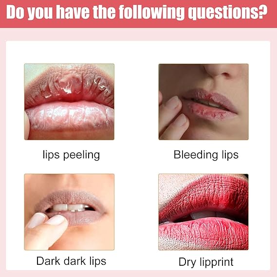 Lips Bleaching Cream Balm / كريم تبييض الشفاه