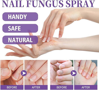 Nail Fungus Spray / رذاذ فطريات الأظافر